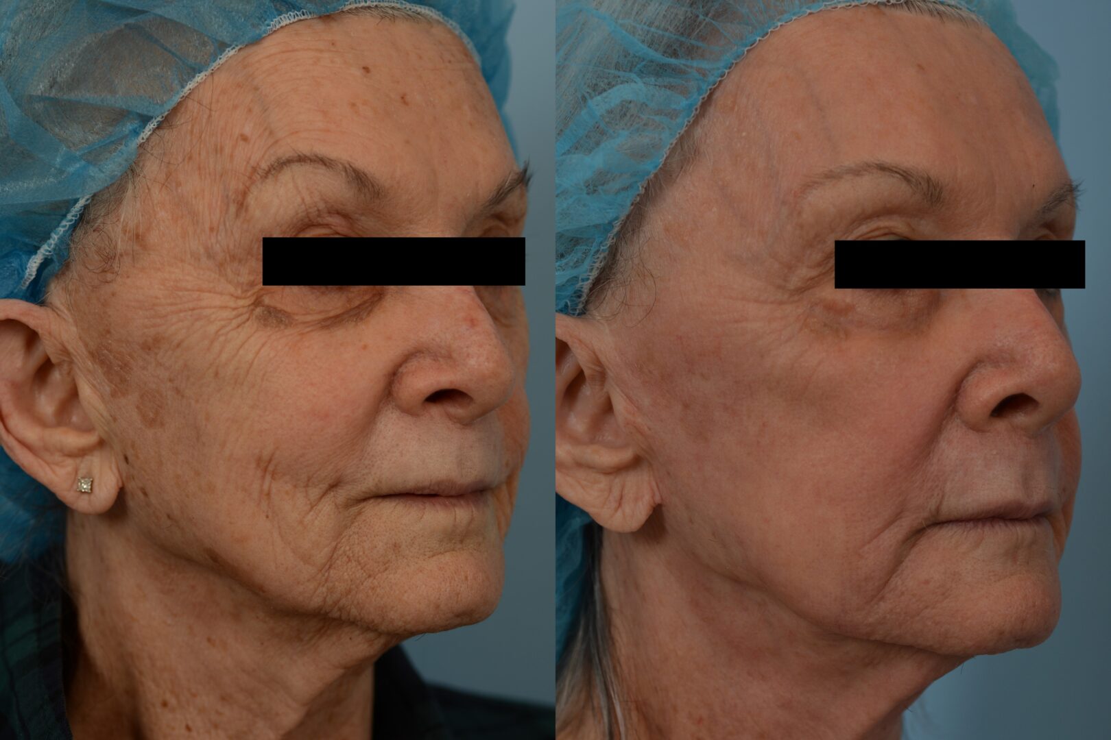 UltraClear® Laser Portland Located Near Beaverton