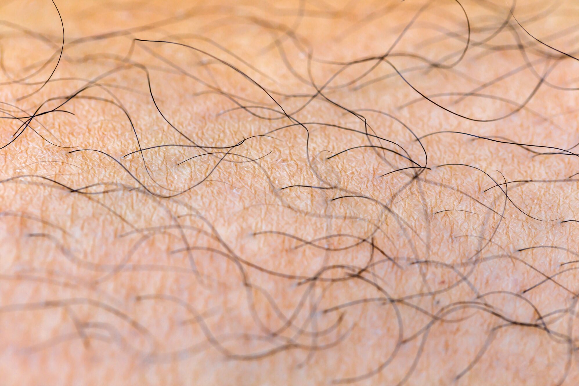 Unwanted Hair on Face & Body in Portland, OR | Key Laser Institute